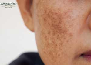 melasma ayurveda treatment