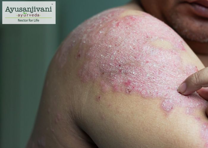 Psoriasis Symptoms : Don't live with psoriasis..treat it with Ayurveda