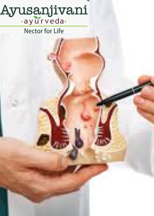 PILES AYURVEDA TREATMENT