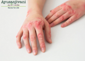 Psoriatic arthritis