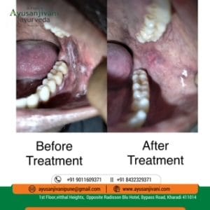 oral sub mucosal fibrosis treatment