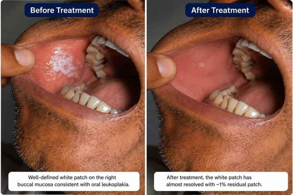 oral submucous fibrosis