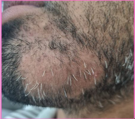 Beard Alopecia treatment