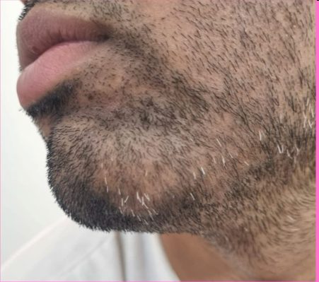 Ayurvedic Alopecia Treatment