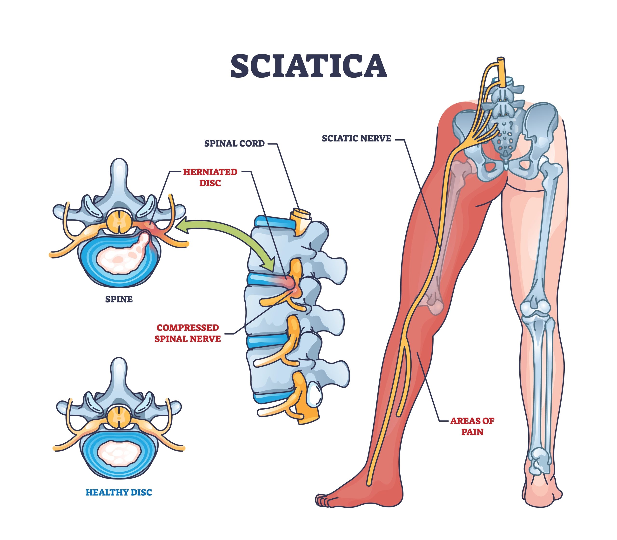 Illustration of common sciatica symptoms including lower back pain and leg numbness