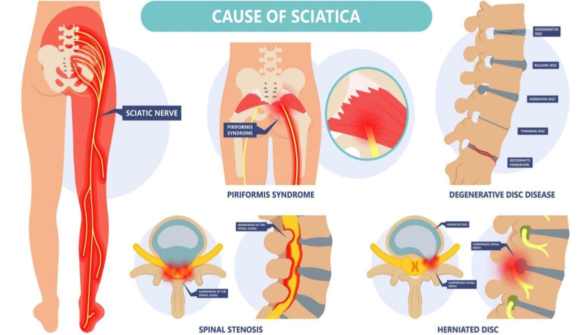Ayurvedic doctor examining a patient's lower back for sciatica diagnosis in Pune clinic