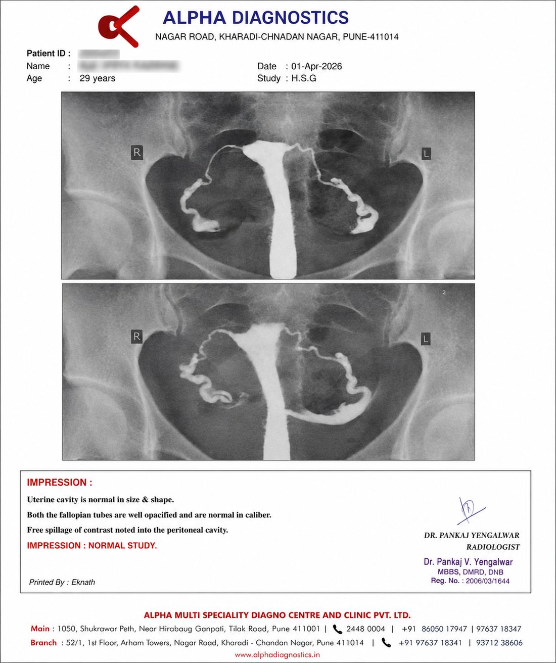 HSG x-ray films after treatment showing bilateral tubal patency