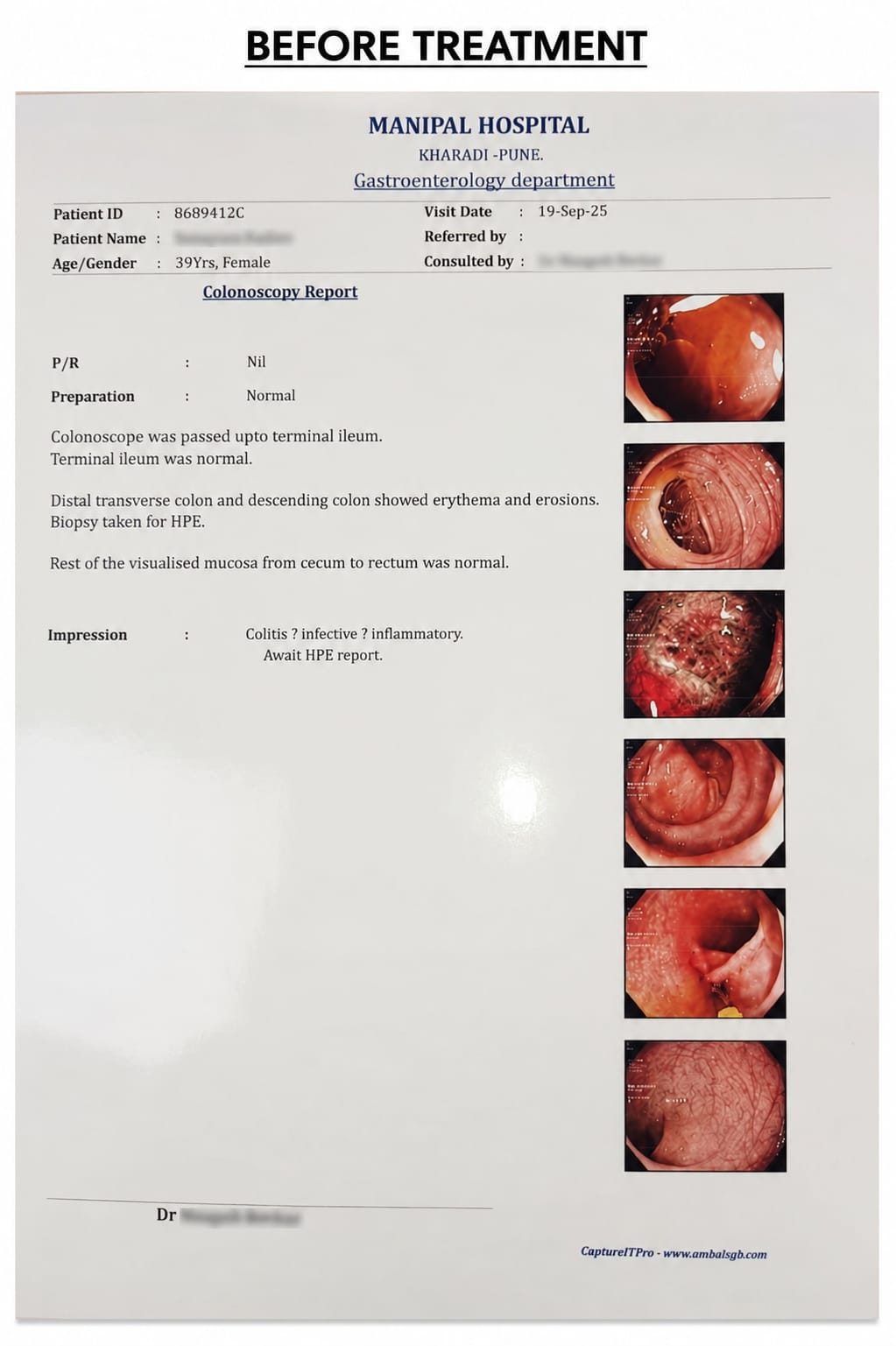 Colonoscopy report, before treatment