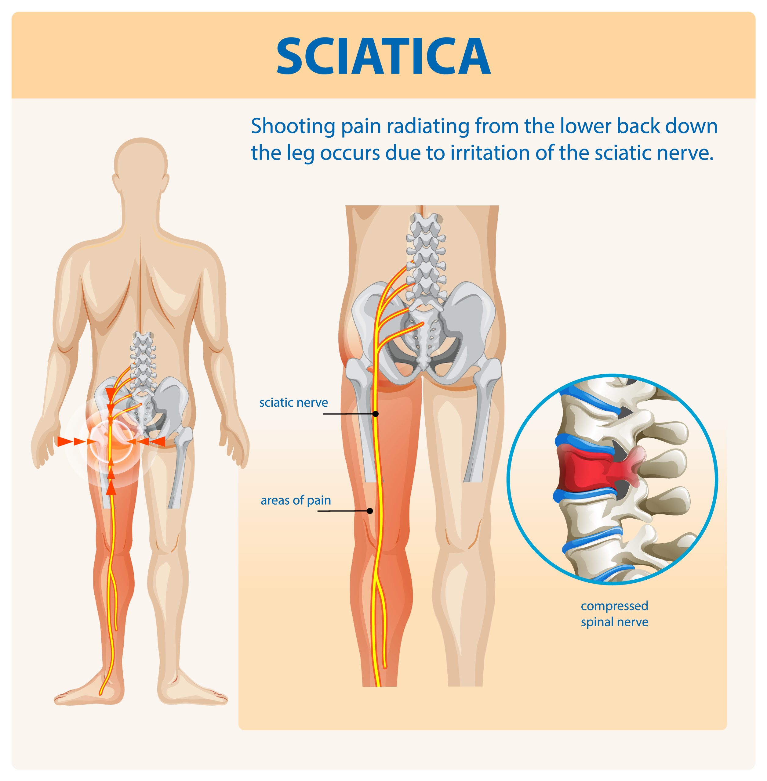 Diagram showing the sciatic nerve path from lower back through hip and leg causing sciatica pain